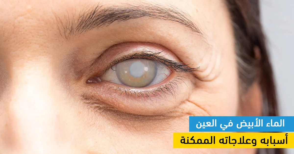 الماء الأبيض في العين : أسبابه وعلاجاته الممكنة